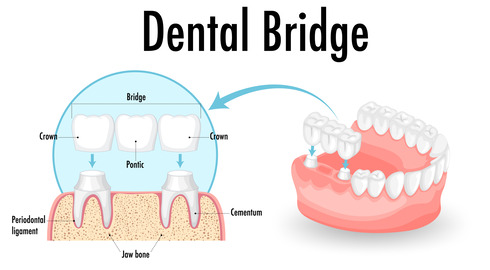 Dental bridge illustration illustration of how a dental bridge works
